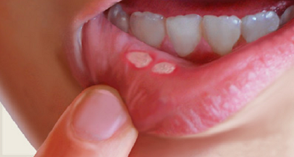 CANKER-SORES-IN-MOUTH-HERE-IS-HOW-TO-NATURALLY-GET-RID-OF-THEM-IN-A-MATTER-OF-MINUTES-WITHOUT-USING-ANY-MEDICINE